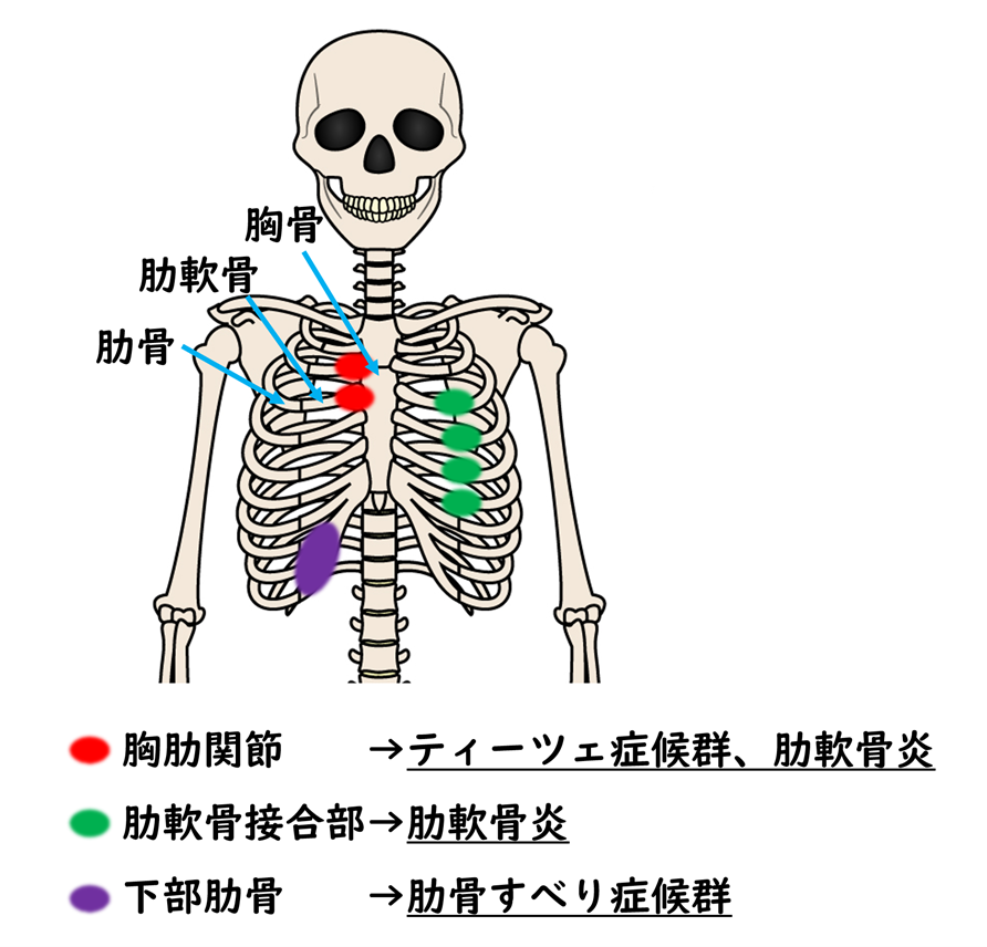 胸の筋肉や肋骨、肋軟骨などの構造と痛みが起こりやすい部位を示すイラスト