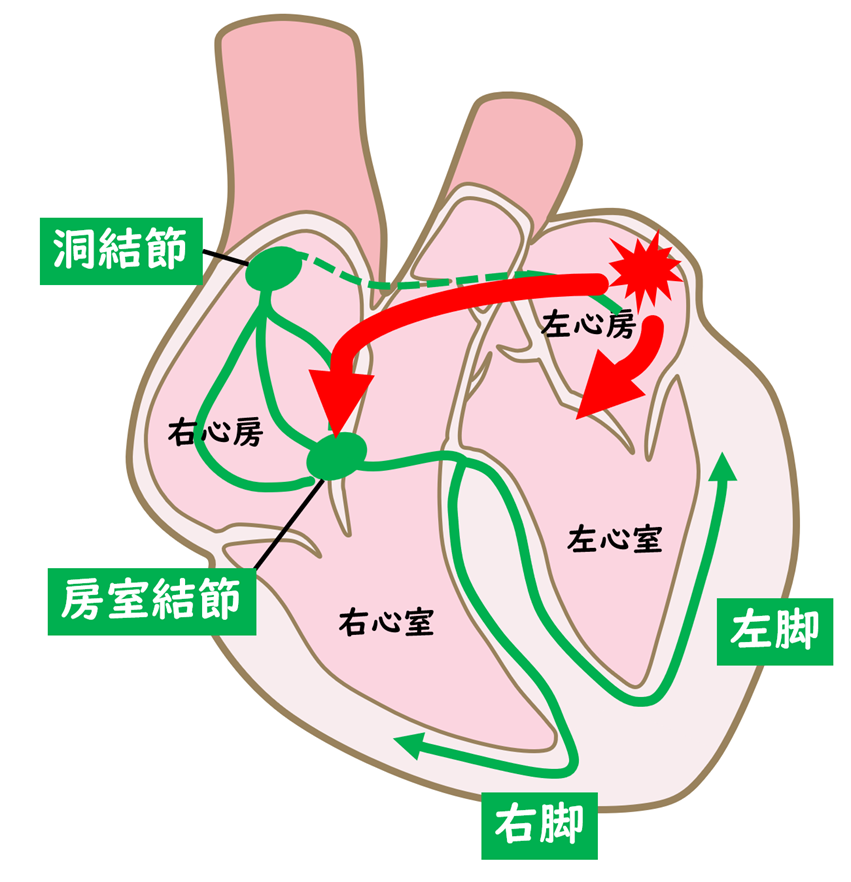 上室期外収縮で心房から予定より早く電気が出る様子を示すイラスト