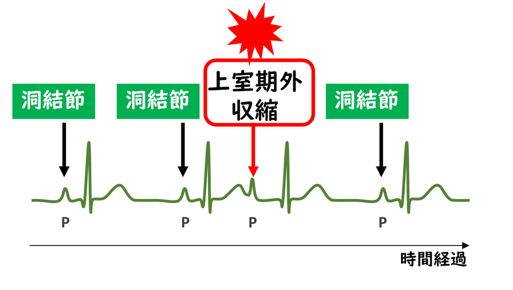 上室期外収縮で通常より早いタイミングにP波が出る心電図のイラスト