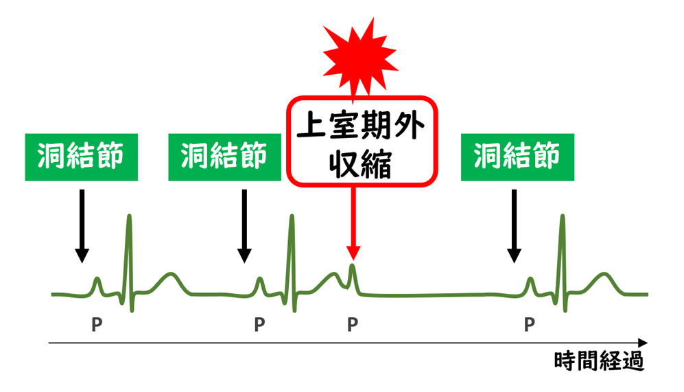 ブロックを伴う上室期外収縮でP波の後にQRS波が出ない心電図のイラスト